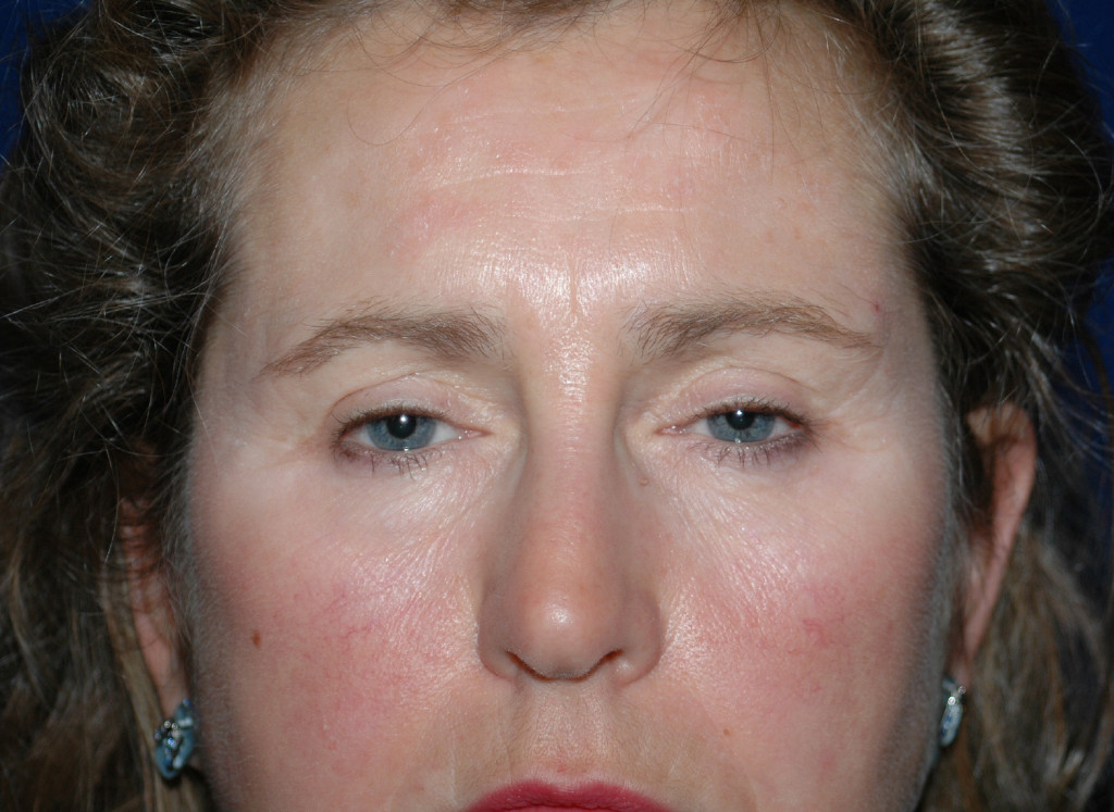 brow lift before and after photos