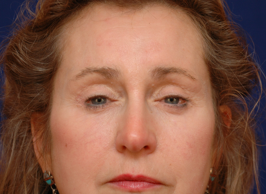 brow lift before and after photos