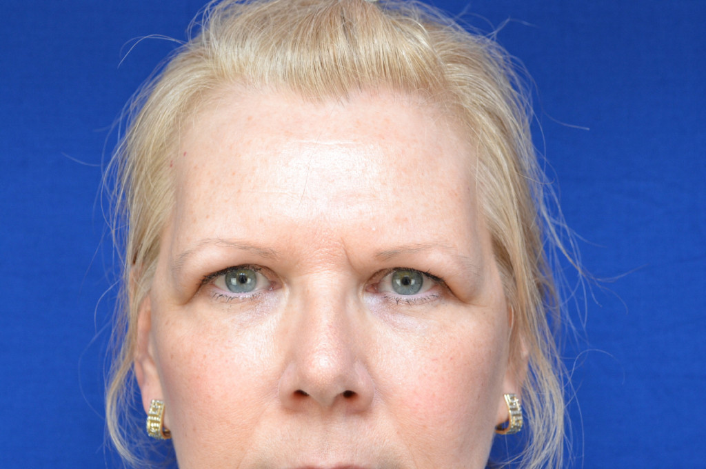 brow lift before and after photos