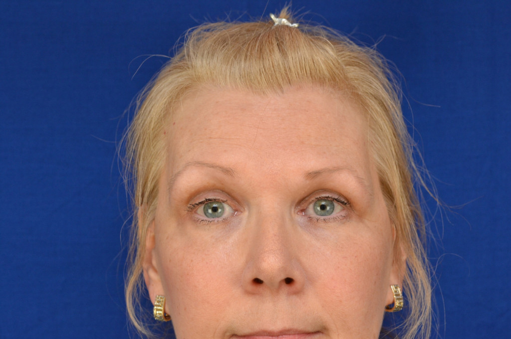 brow lift before and after photos