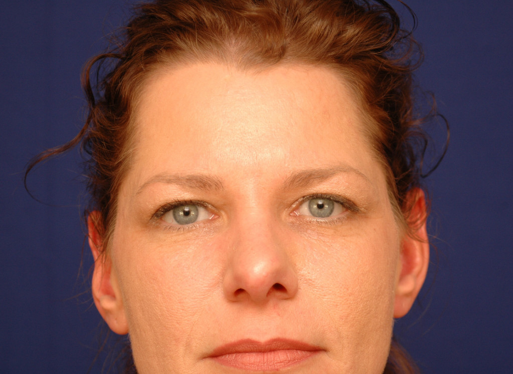 brow lift before and after photos