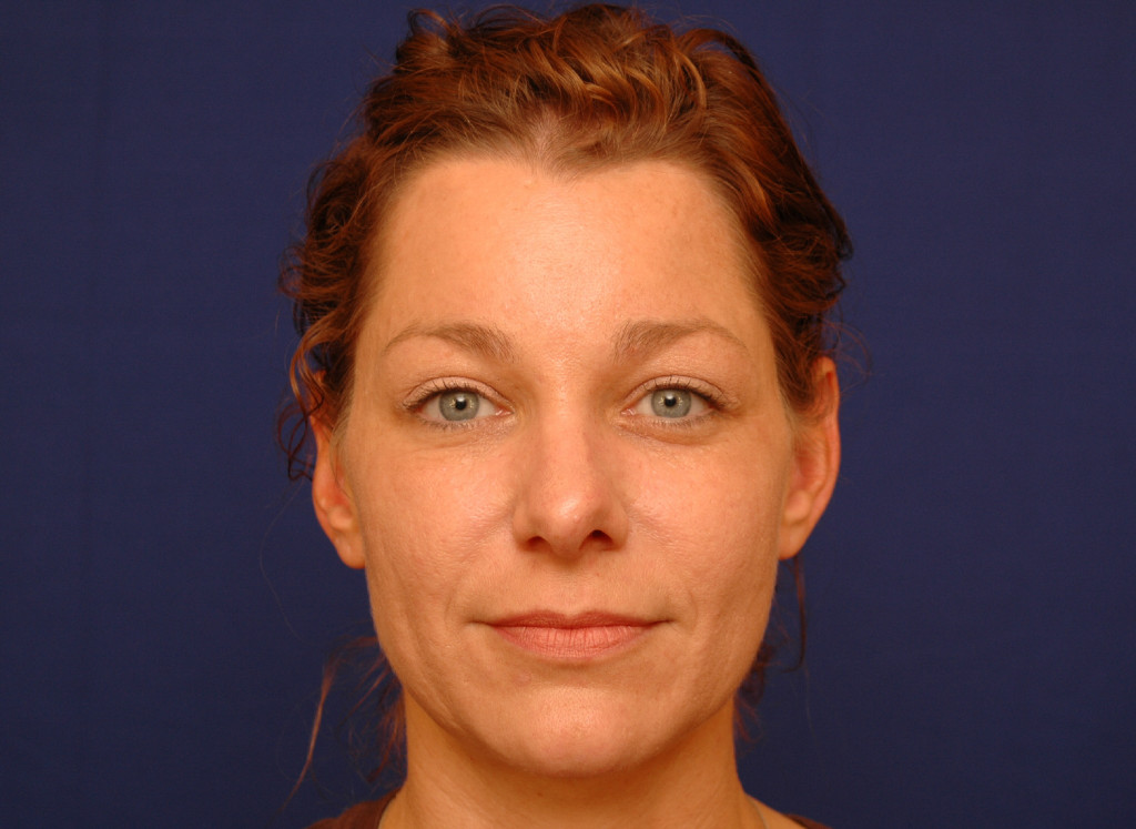 brow lift before and after photos
