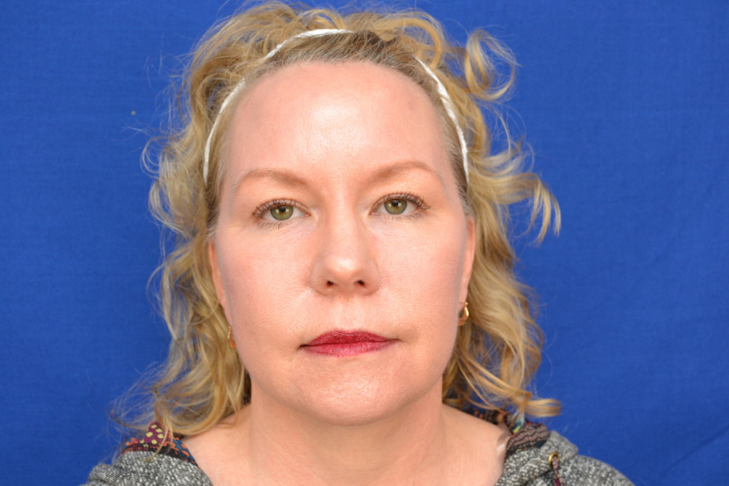 brow lift before and after photos