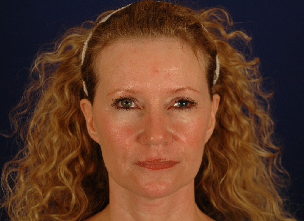 brow lift before and after photos