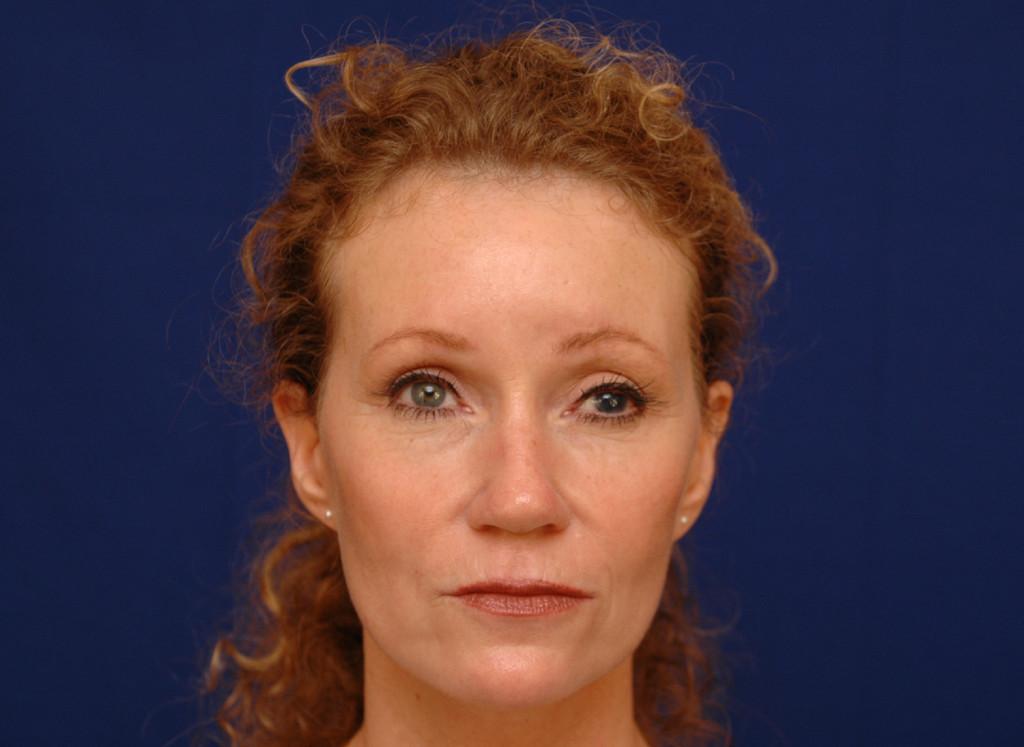 brow lift before and after photos