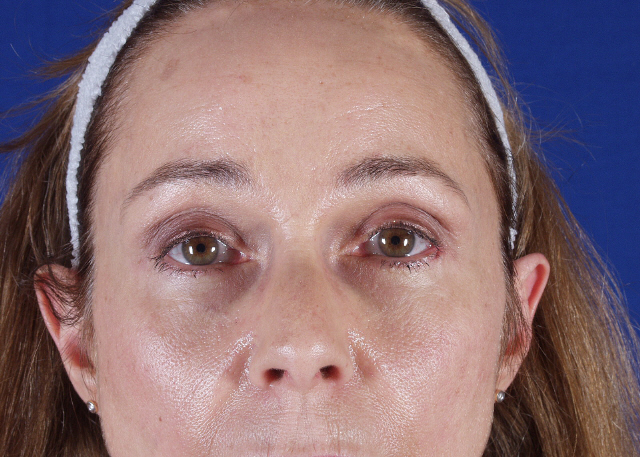 brow lift before and after photos