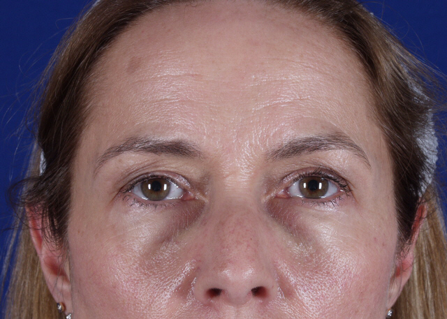 brow lift before and after photos