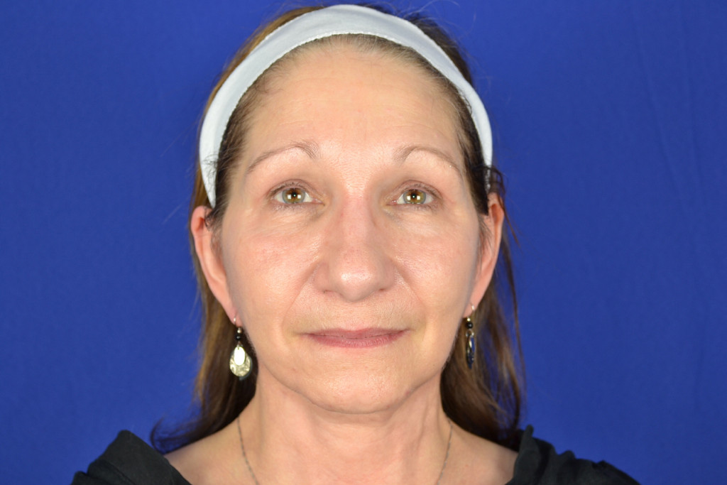 forehead lift before and after