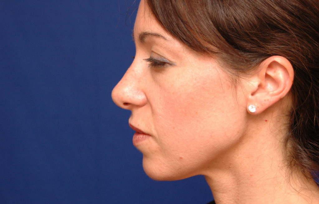 cheek implants before after