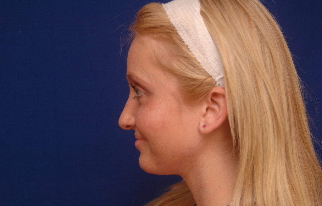 cheek implants before and after pictures