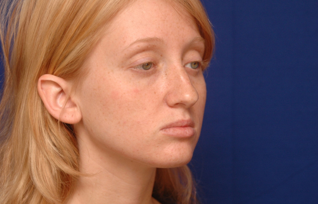 cheek implants before and after pictures