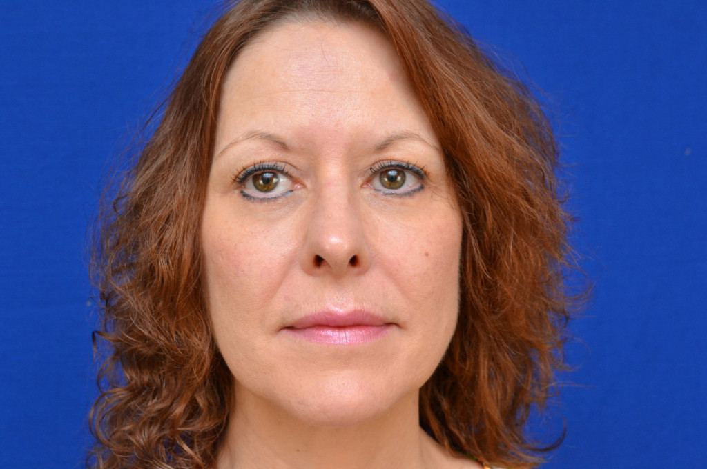 cheek implants before and after pictures