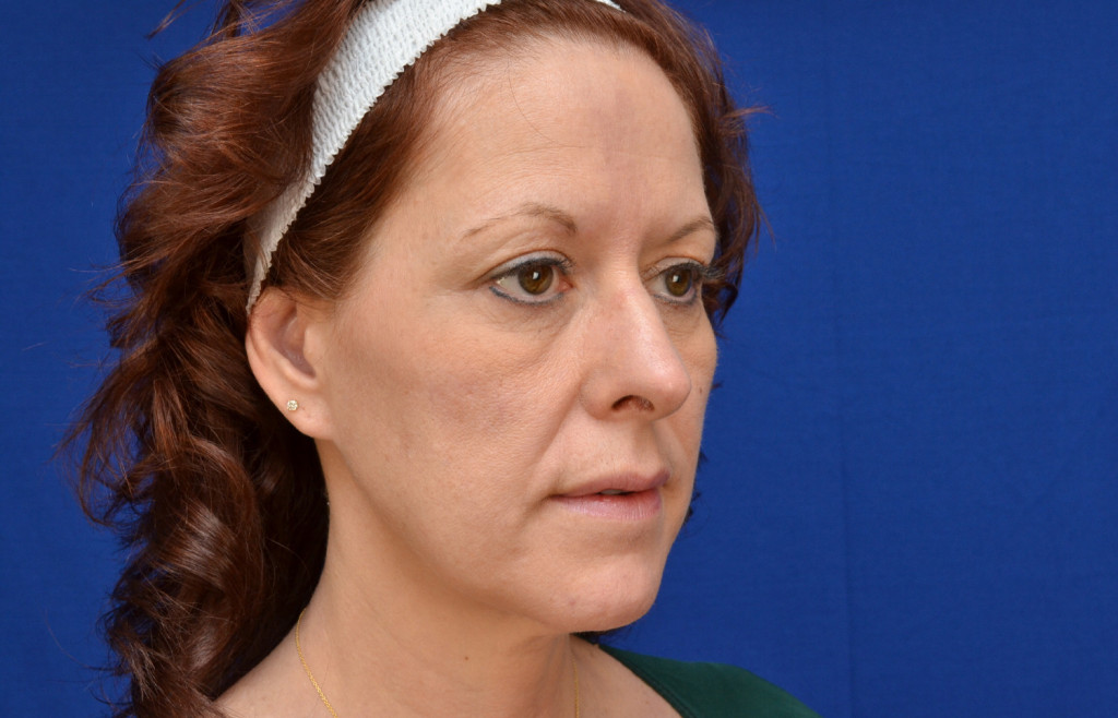 before cheek implant pictures