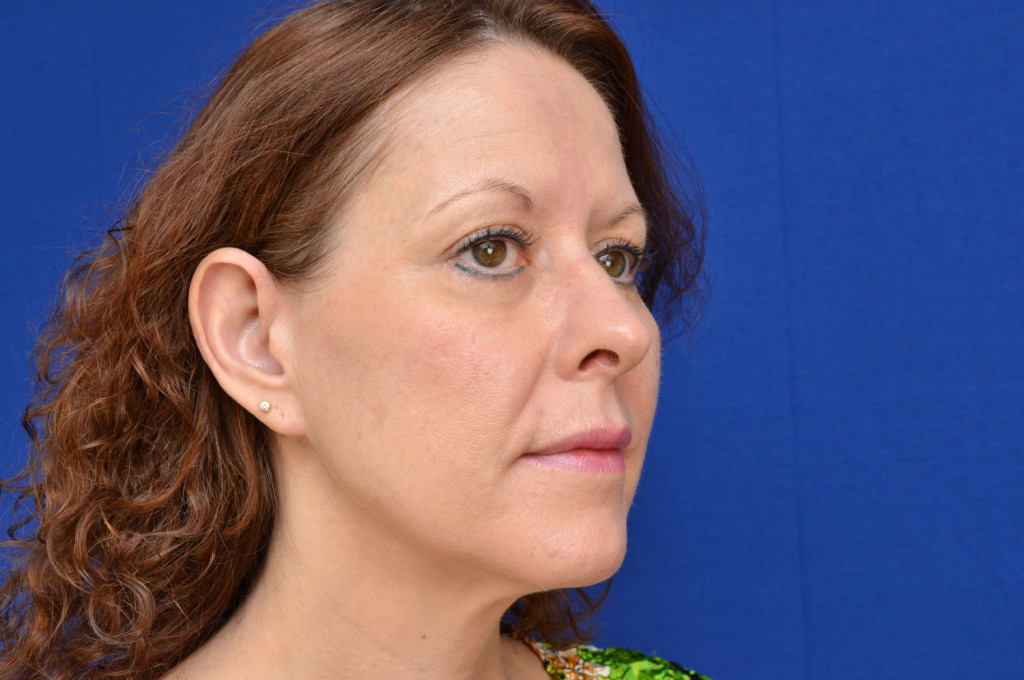 after cheek implant pictures