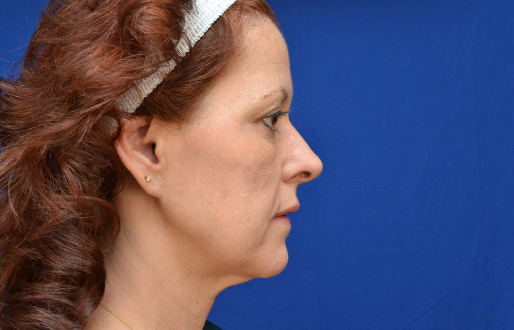 cheek implants before and after pictures