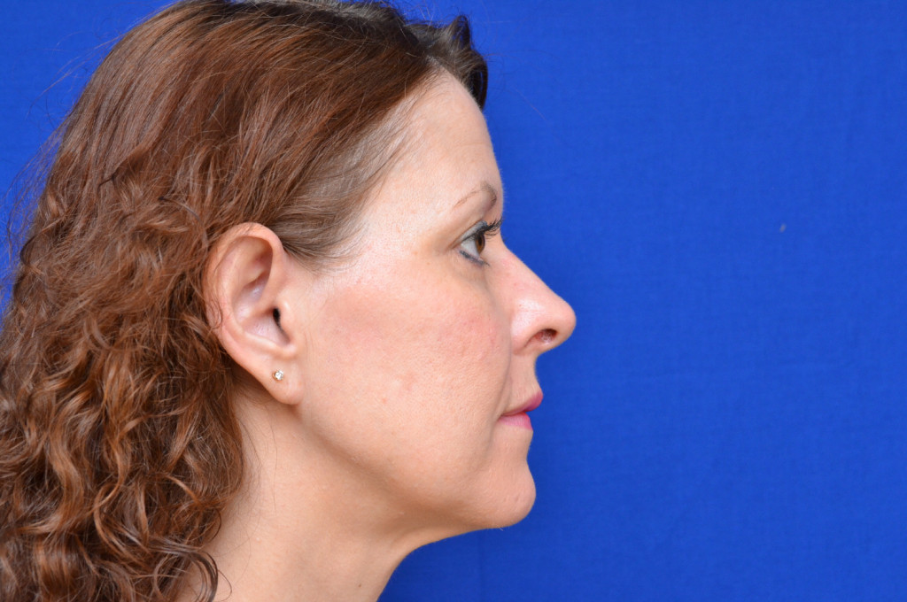 cheek implants before and after pictures
