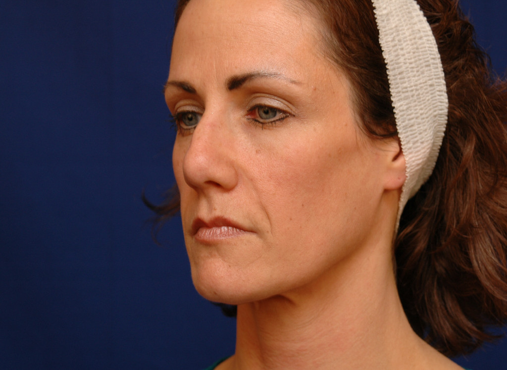 cheek implants before after