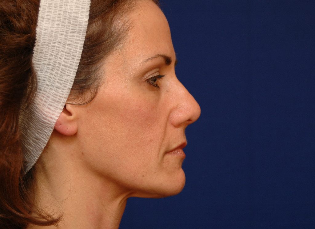 cheek implants before and after pictures