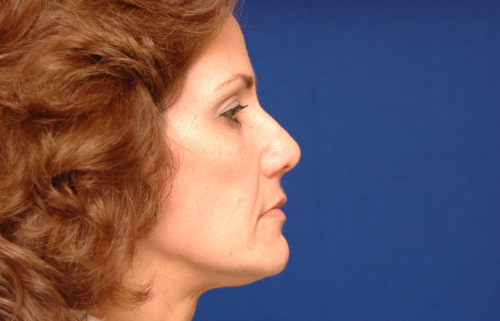 cheek implants before and after pictures