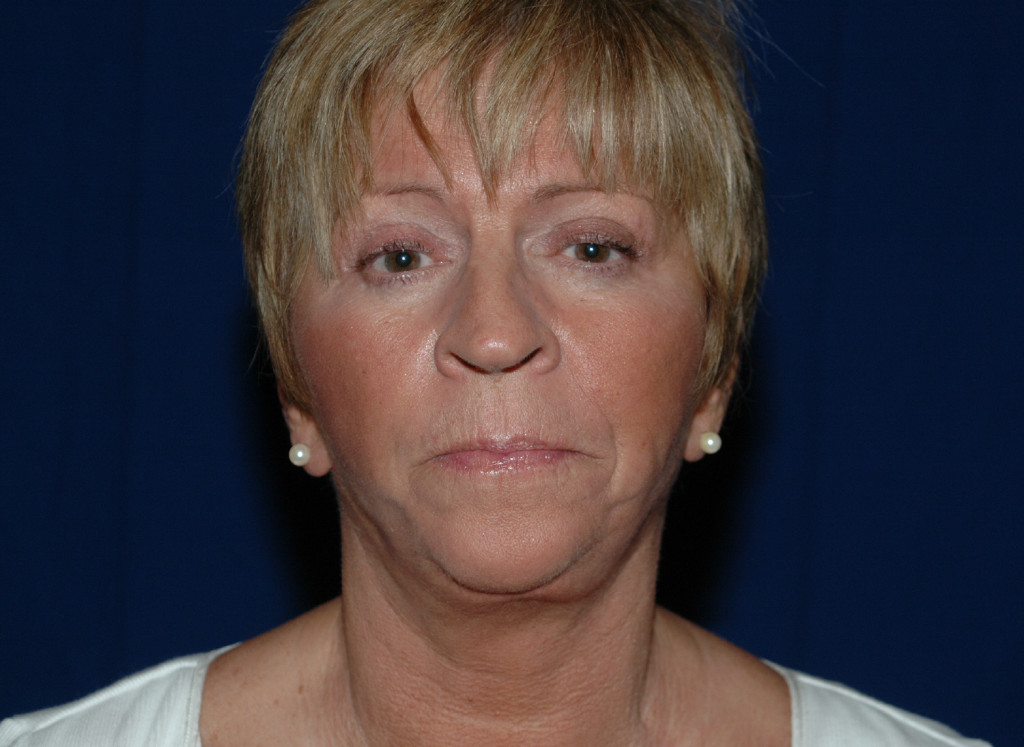cheek implants before and after pictures