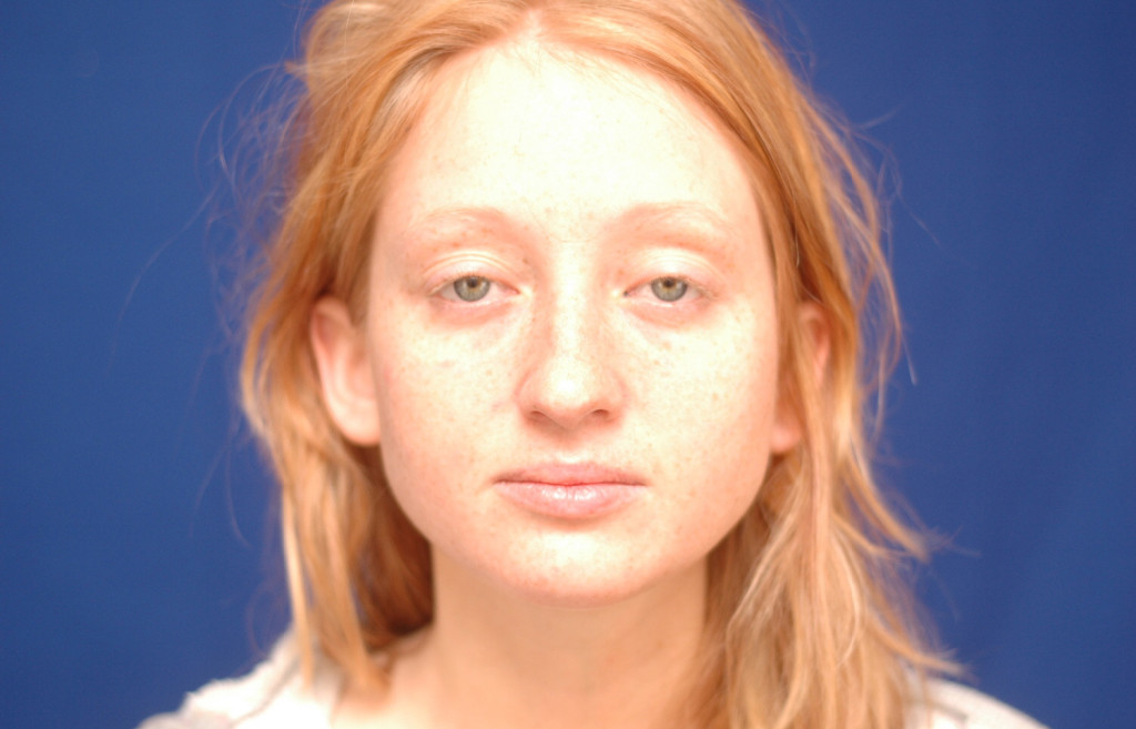 cheek implants before and after pictures
