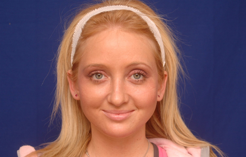 facial implants before and after photos