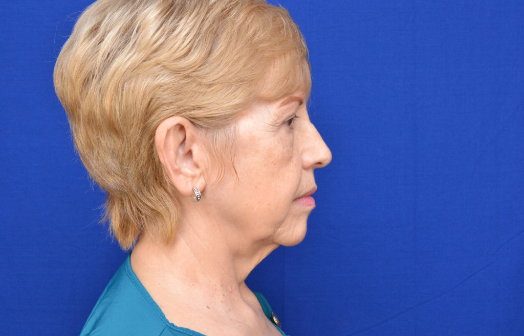 facelift before and after pictures