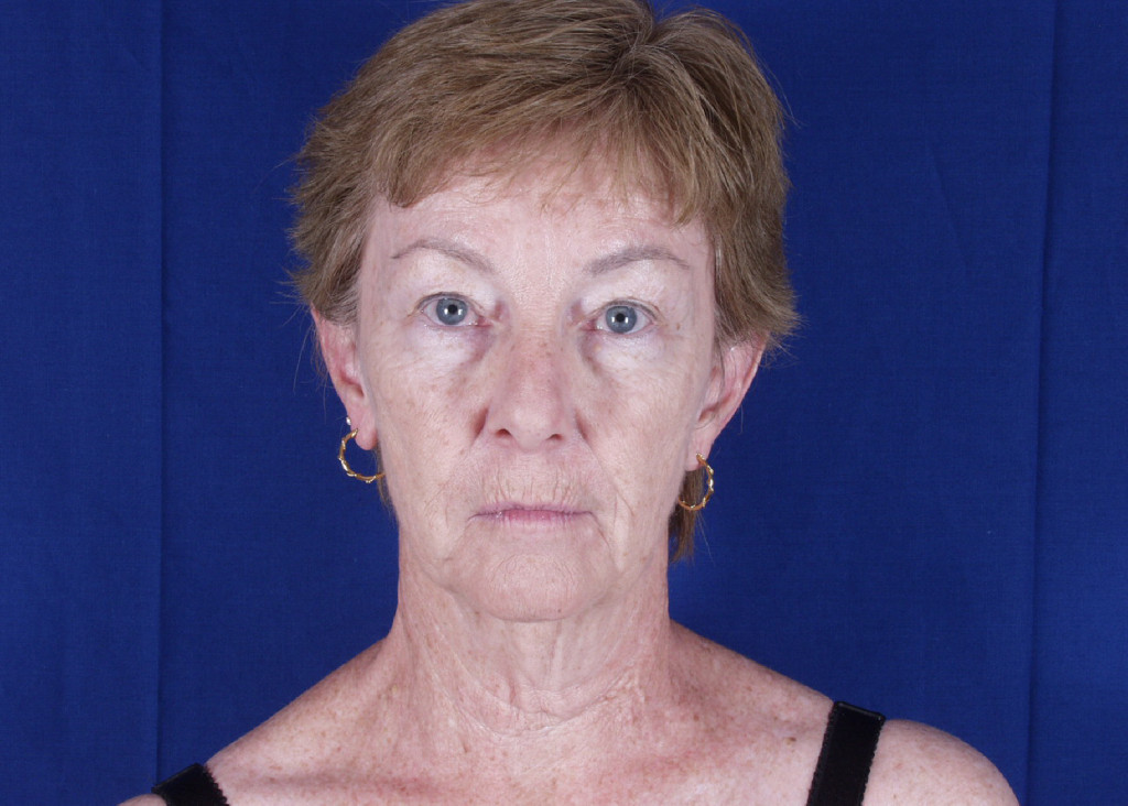 facelift before and after pictures