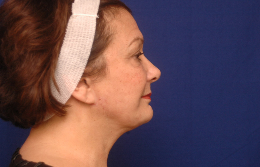facelift before and after photos