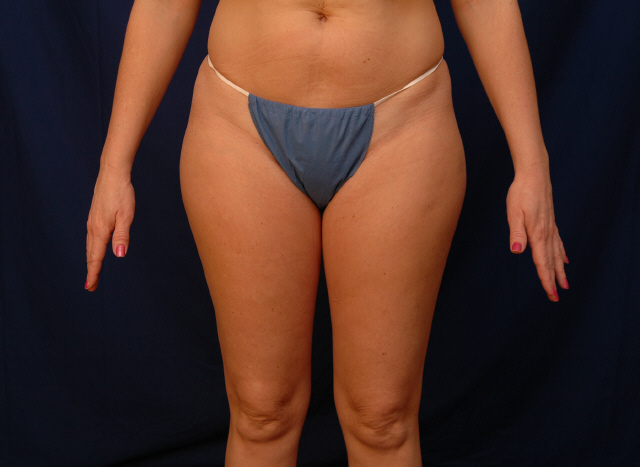lipo before and after pictures