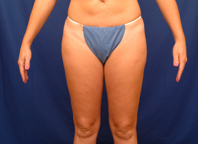 lipo before and after pictures