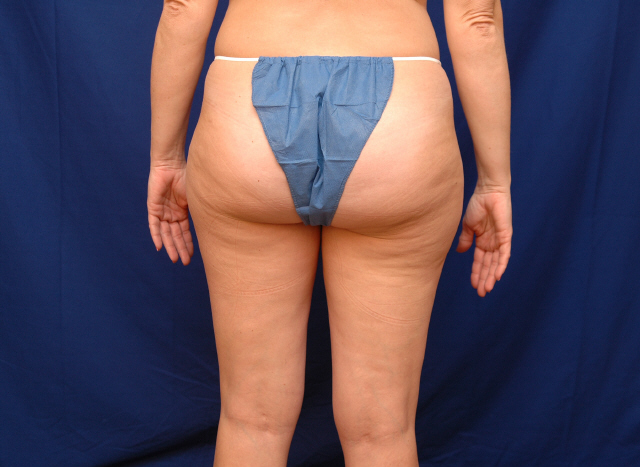 lipo before and after pictures