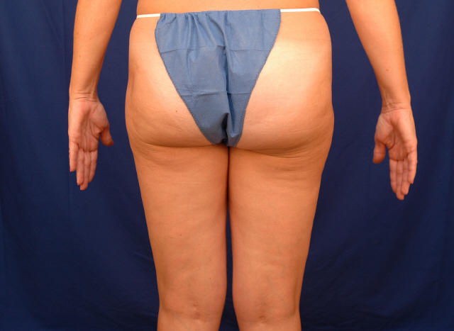 liposuction before and after pictures