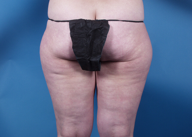 liposuction before and after photos