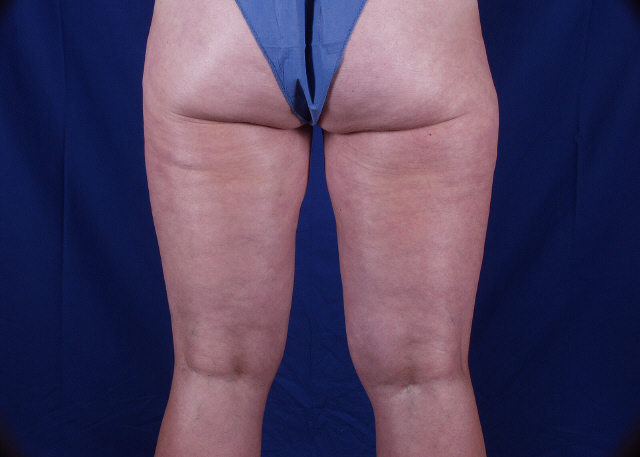 liposuction before and after photos