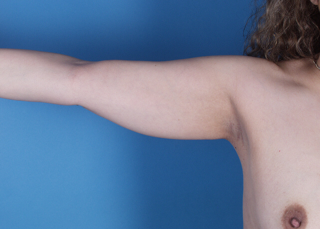 arm liposuction before and after pictures