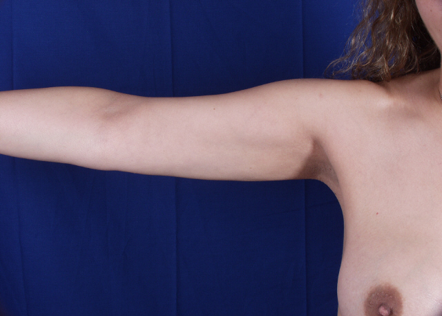 arm liposuction before and after pictures
