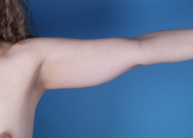 liposuction before and after pictures