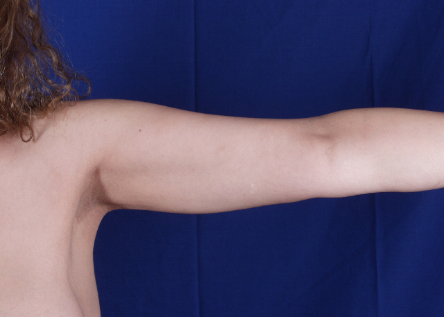 liposuction before and after pictures