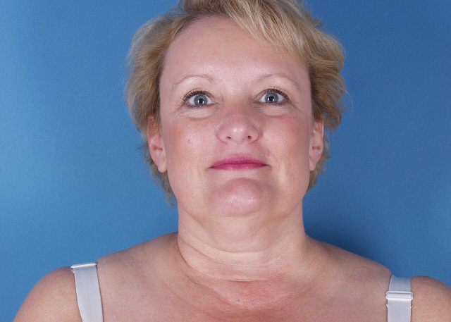 neck liposuction before and after pictures
