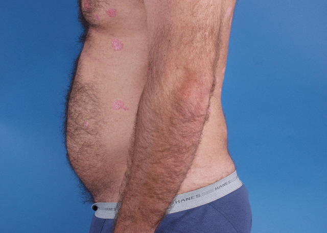 liposuction before and after photos