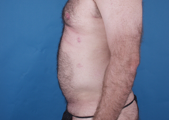 liposuction before and after photos