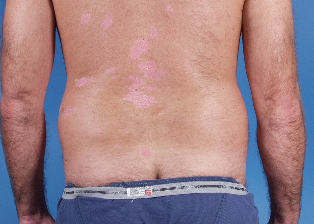 liposuction before and after photos