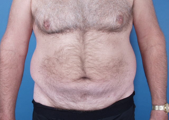 liposuction before and after photos