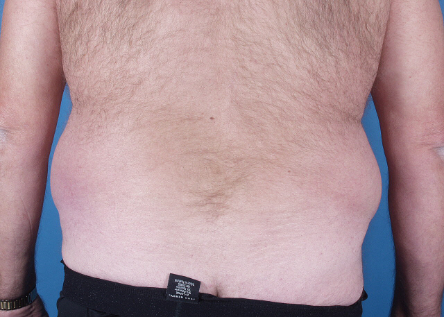 liposuction before and after photos