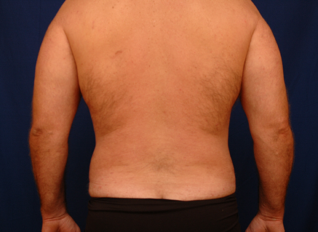 lipo before and after photos