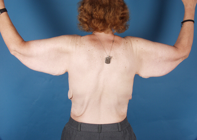 Arm Lift Before and After photos