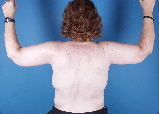 Arm Lift Before and After photos