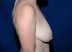 breast reconstruction before and after photos