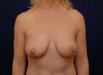 breast reconstruction before and after
